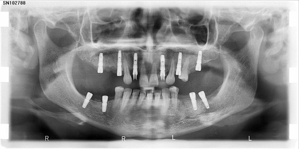 Fig. 2 Initial appearance of the paraclinic evaluation Perfect positioning and dimensional superstructures are essential for welldesigned to mime the appearance of natural teeth and to achieve