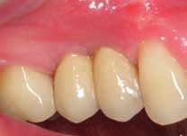 The all-ceramic crowns were cemented with ImplaTemp cement, and the treatment session concluded with occlusion and articulation checks (Figs. 20 and 21).