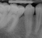 Porcine Straumann Emdogain Enamel matrix derivative Emdogain in oral regeneration Periodontitis is associated with a loss of tooth-supporting tissues which is irreversible and the main reason for