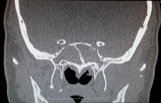 THE CASE A fifty-eight-year-old male patient presented with bilateral diplopia, severe unilateral facial pain, nasal blockage, photophobia, headache and gait disturbance.