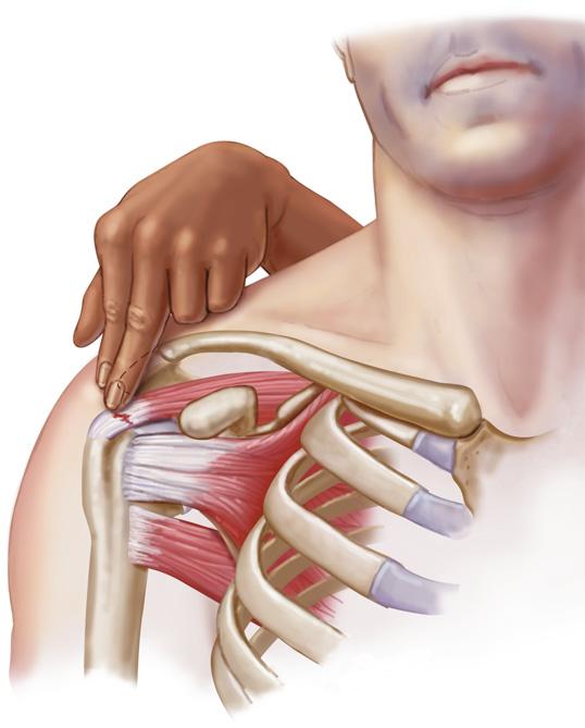 Palpation Reliability of Palpating the Subacromial Space ICC or Interpretation.81-1.0 Substantial agreement.61-.80 Moderate agreement.41-.60 Fair agreement.11-.40 Slight agreement.0-.