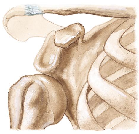 10 No agreement Subcoracoid dislocation (most common) Subglenoid dislocation Subclavicular dislocation (uncommon).