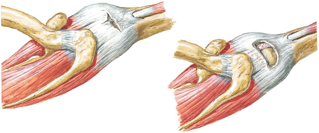 Special Tests Rotator Cuff Tears Reliability of Special Tests for Identifying Supraspinatus and/or Infraspinatus Tears ICC or Interpretation.81-1.0 Substantial agreement.61-.80 Moderate agreement.41-.