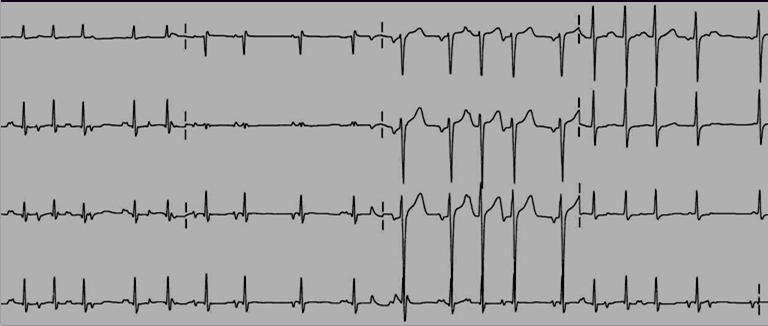 (Atrial flutter, Vtach) A 60 yo with COPD c/o palpitations & SOB. The EKG shows: a. Atrial Fibrillation b. Premature Atrial Complexes c. Multi-Focal Atrial Tachycardia d.