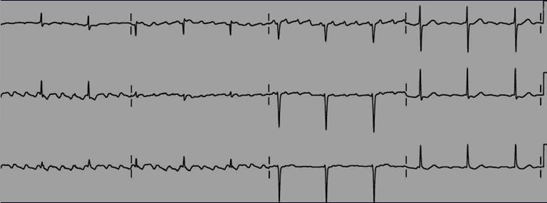 B. ATRIAL FLUTTER : Rapid, regular flutter (F) waves at 250-350 per minute (ventricular