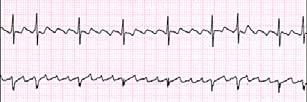 of atrial activity in lead 1 AV conduction variable, QRS typically normal width Enhanced