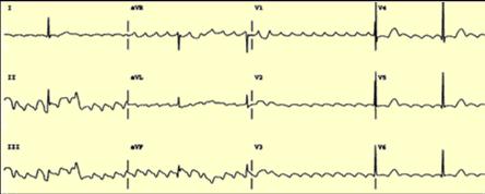 electrosensitive of all dysrhythmias therefore cardioversion is the treatment of choice for