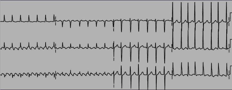 Drug of choice for diagnostic purposes is Adenosine (as long as QRS is narrow ATRIAL FLUTTER -
