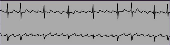 Same patient after adenosine, showing prominent flutter waves. A 46 year old presents with palpitations.