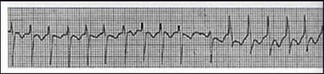 will be able to convert to NSR Ashman s phenomenon short runs of wide complex tachycardia during rapid atrial fibrillation.