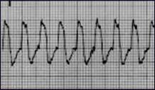 SVT with Aberrancy (rate-related block) SVT with aberrancy is a supraventricular tachycardia with a widecomplex QRS due to a raterelated bundle branch block.
