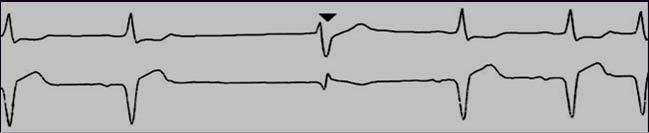 DYSRHYTHMIAS OF VENTRICULAR ORIGIN Idioventricular rhythms Ventricular Tachycardia Ventricular Fibrillation Torsades de pointes VENTRICULAR DYSRHYTHMIAS - Etiology V Tach, V Fib & Idioventricular