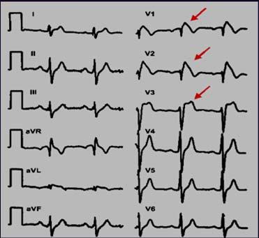 Mag Unstable : Unsynchronized defibrillation plus meds VENTRICULAR FIBRILLATION Chaotic ventricular depolarization with loss of