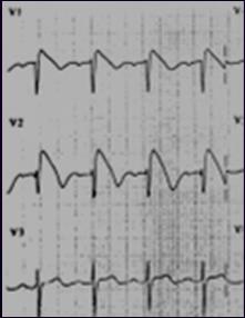 unsynchronized defibrillation at 200, 300, then 360 joules (if Biphasic use ½ dose or 150j) Brugada Syndrome: ST elevation V1-3 with