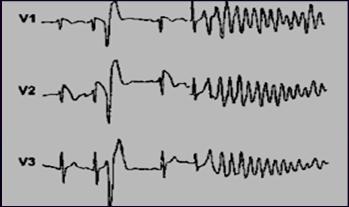 Brugada Syndrome: Look for ST elevation V1-3 part of the syncope or palpitation work-up immediate cardiology referral for ICD placement