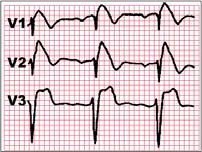 tachycardia often respond to 50 joules Atrial and Ventricular FIBRILLATION require 100 joules or more Biphasic defibrillators use half the