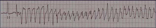 QUESTION ~ All of the following cause Torsades de pointes, except: A. Hypomagnesemia B.