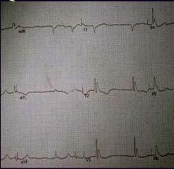 downstroke of QRS Tricyclic