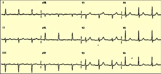 Differential Diagnosis LAD : LBBB, LAFB, Mechanical shift