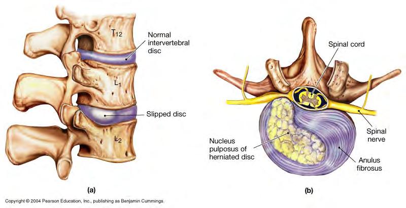 -intervertebral foramen maintained by intervertebral discs between vertebrae Herniated disc