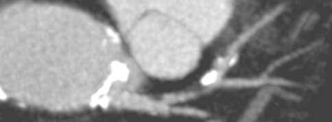 stenosis Stable angina Asymptomatic