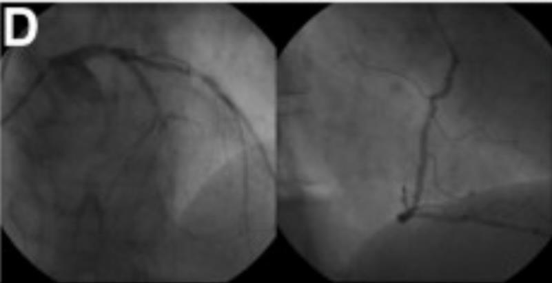 A 61-yearold patient with DM, HT Severe occlusion of the LAD 80% stenosis in the proximal LCX Sequential 50% to 60% lesions in RCA Cardiac