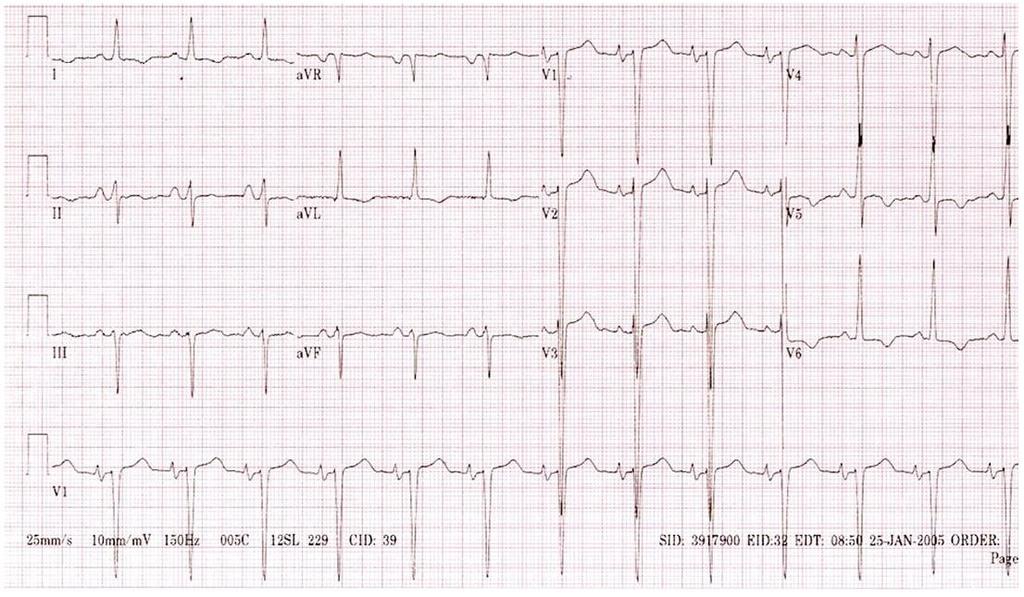 The baseline ECG demonstrates sinus rhythm, increased QRS voltage consistent with left ventricular hypertrophy