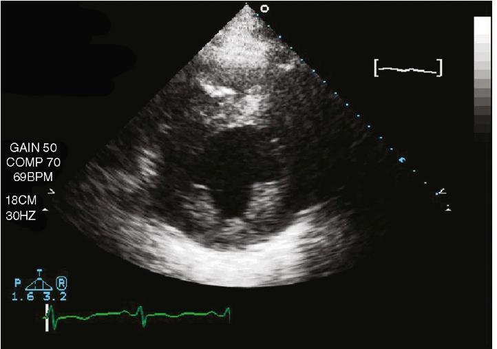 Echocardiography Parasternal long-axis Short-axis LV dilation: