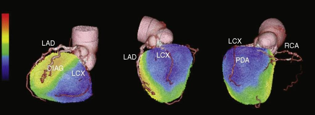 Dual-modality imaging In patients with multivessel CAD Dual-modality imaging would allow better localization of the culprit stenosis and offer a more targeted approach to
