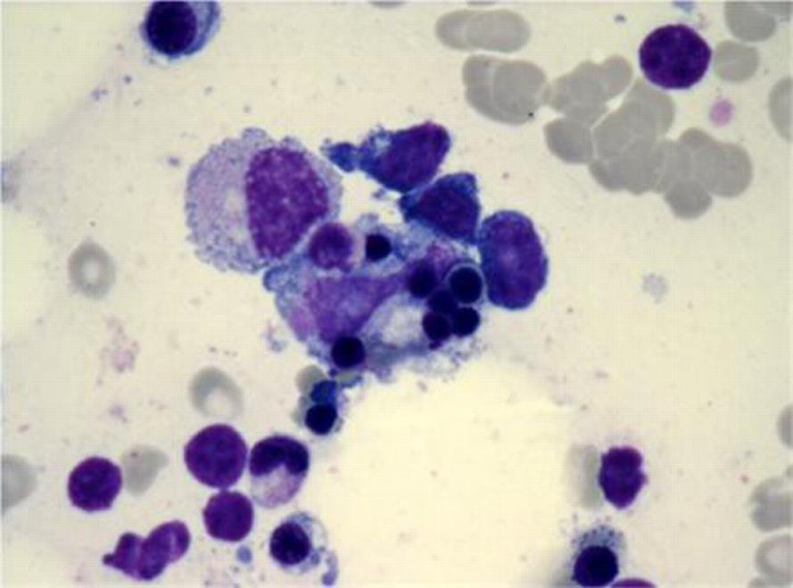 Haemophagocytosis Lacks sensitivity and specificity for HLH May not be