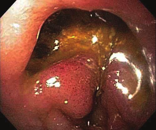 Approach to the patient with gross gastrointestinal bleeding CHAPTER 1 Figure 1.