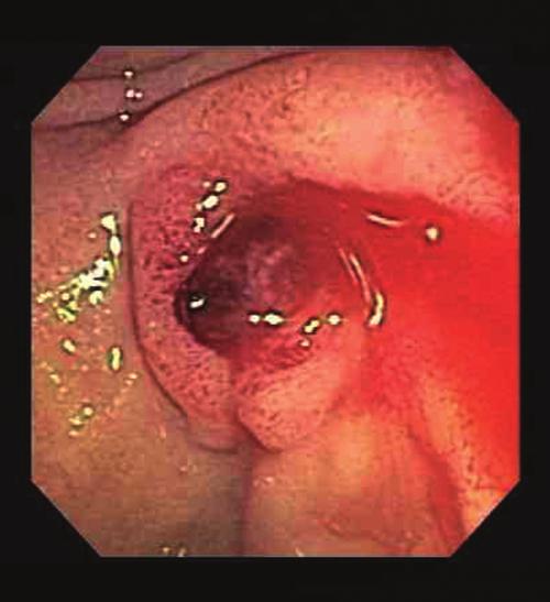 An upper endoscopy revealed visible aortic graft with distal oozing of blood in the third portion of the duodenum. Figure 1.