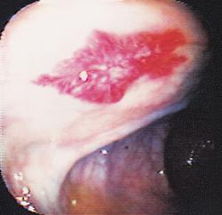Two previous upper endoscopic examinations did not show a bleeding source.