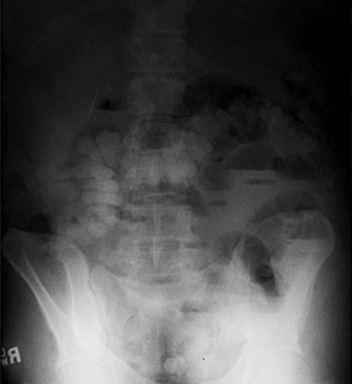 gastro intestinal obstruction 14 Fecal Impaction Complete colonic obstruction secondary to fecal impaction in the rectum can sometimes be successfully relieved through disimpaction at the bedside;
