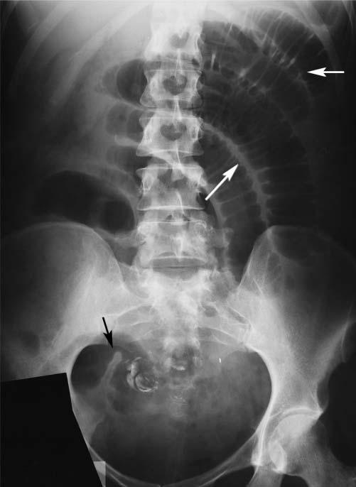 gastro intestinal obstruction 5 Figure 2 Supine radiograph from a patient with complete small bowel obstruction shows distended small bowel loops in the central abdomen with prominent valvulae