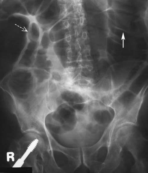 Note the presence of an isolated small bowel loop in the right lower quadrant (black arrow), which is seen fixed in the same location on upright films, as shown in Figure 5.