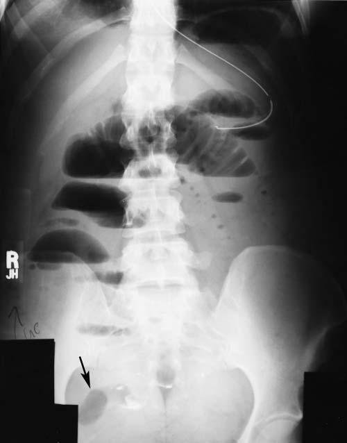 gastro intestinal obstruction 6 Figure 5 Upright radiograph from the same patient as the supine radiograph in Figure 2 shows multiple air-fluid levels of varying size arranged in inverted Us.