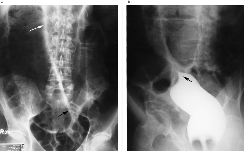 gastro intestinal obstruction 7 Figure 6 (a) Radiograph from a patient with massive sigmoid volvulus shows a distended ahaustral sigmoid loop (white arrow), inferior convergence of the walls of the