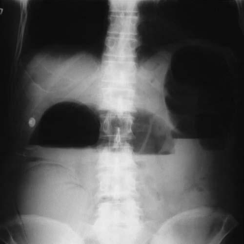 gastro intestinal obstruction 8 Figure 8 Radiograph from a patient with complete colonic obstruction from an obstructing carcinoma in the descending left colon with proximal air-fluid levels.