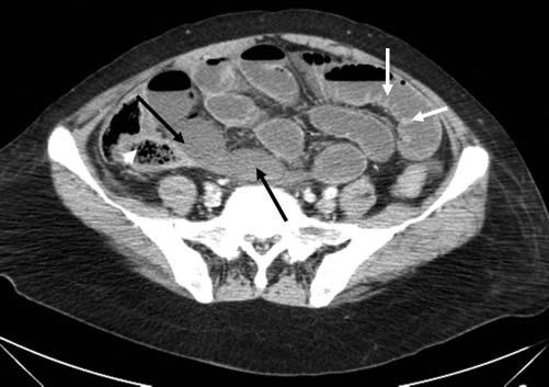 arrow). This patient was markedly tender and acidotic and had a leukocytosis. She was taken for laparotomy and found to have a small section of ischemic small bowel that was resected.