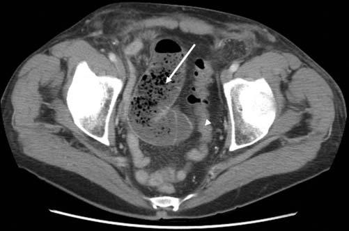 There is mesenteric edema (black arrowhead) and, importantly, pneumatosis intestinalis (black arrow), which can be distinguished from air within the bowel lumen given its appearance in antidependent