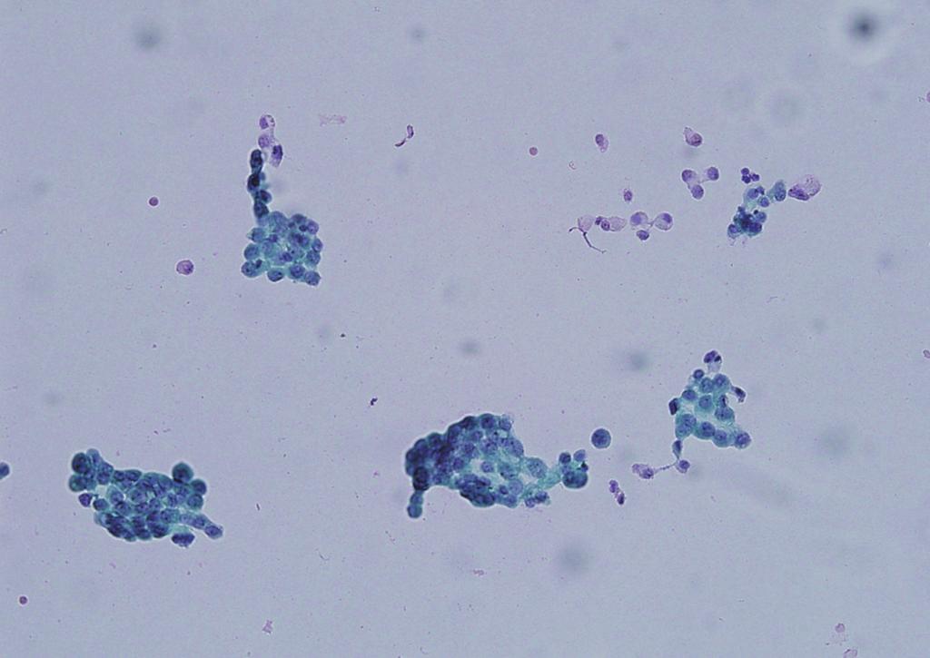 Malignant Pleural Effusion from PTC 331 Fig. 1. Pleural fluid cytology of patient 1, which shows papillary structure of columnar cells ( 400). metastatic nodule. Radio-frequency ablation and 7.