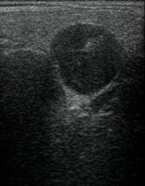 Primary lymphoma of the thyroid Rare primary tumor Associated with Hashimoto's