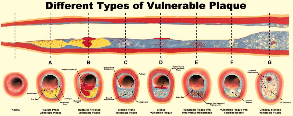 able plaque versus vulnerable patient able Plaque = plaques prone to thrombosis or high probability of rapid progression, i.e. becoming culprit plaques (responsible for occlusion and death) able