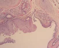 Malignant tumors - classification Lung Tumor Classfication Malignant epithelial tumors Small