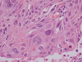 Squamous carcinoma Usually of bronchogenic origin; however can also arise from peripheral areas of squamous metaplasia Frequently have central necrosis Faster doubling time than adenocarcinoma; often