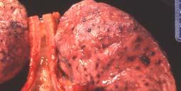 Metastatic Carcinoma The lung is a frequent site of metastatic