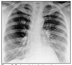 Pulmonary Osteoarthropathy Endocrine SIADH (sclc) Hypercalcemia (squamous) Cushings Syndrome (sclc) Neurologic Horners Syndrome Eaton-Lambert syndrome (sclc) Vascular