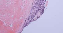 cell carcinoma Carcinoids