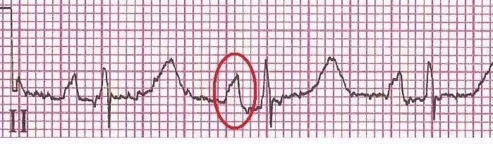 5 small boxes P-mitrale seen in left atrial